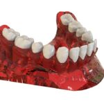 zirconium oxide dental implants