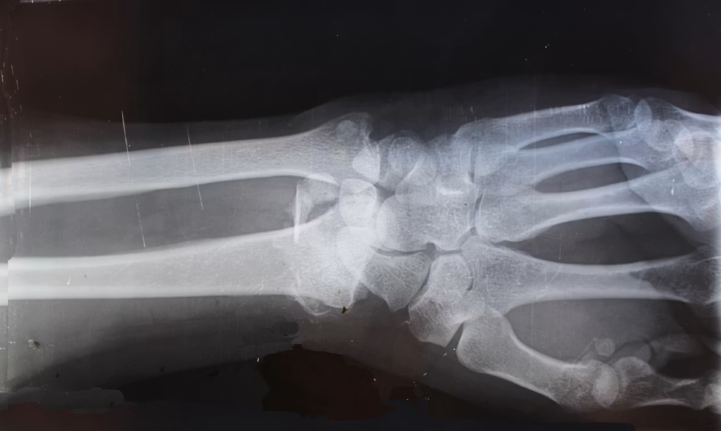Is Fixation the Key to Successful Plate Repair in Small Metacarpal Fractures in Horses