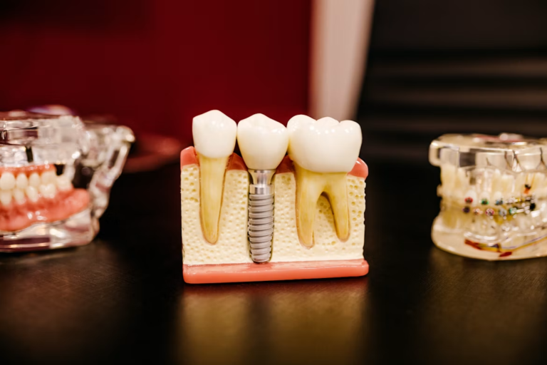 Are Zirconia Implants More Resistant to Microbial Colonization Than Titanium