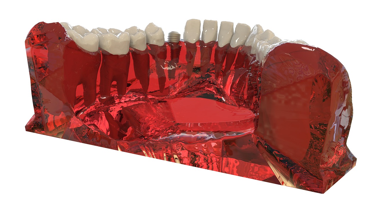 teeth, jaw, 3d model, orthodontics, the implant