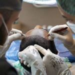 hair transplant, treatment, surgery, procedure, scalp, head, dermatology, hair transplant, hair transplant, hair transplant, hair transplant, hair transplant