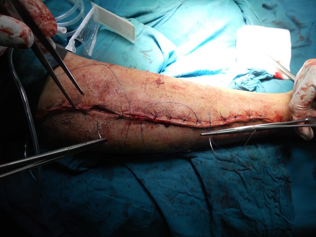 surgery, orthopedic, arm, hospital, doctor, healthcare, medicine, body, anatomy, clinic, stitched, injury, surgery, orthopedic, orthopedic, orthopedic, orthopedic, orthopedic, doctor, injury