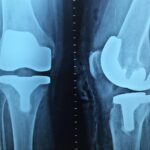 doctor, orthopedics, x-ray, knee, orthopedics, orthopedics, orthopedics, orthopedics, x-ray, x-ray, x-ray, x-ray, x-ray, knee, knee, knee, knee